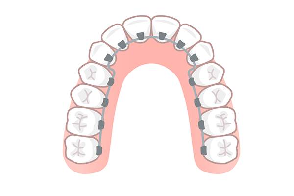 ワイヤー矯正（裏側矯正・舌側矯正）