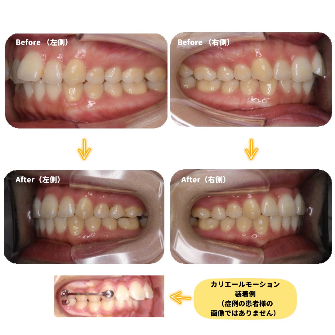 21歳7ヶ月の女性のマウスピース矯正症例